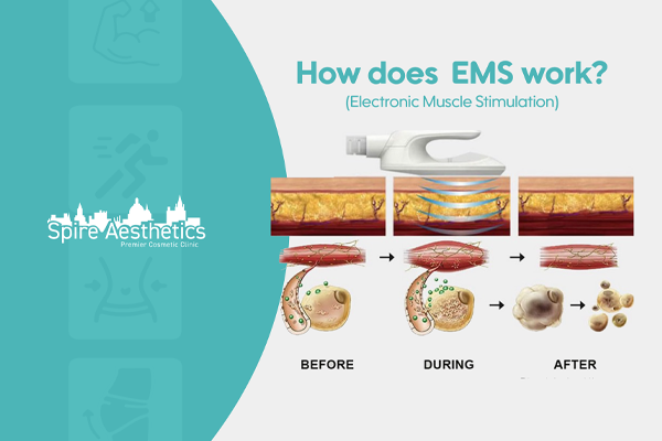 EMS treatment for post pregnancy weight loss treatment Owsestry