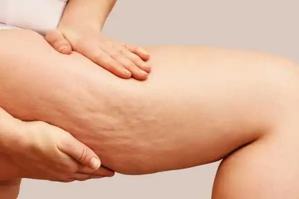 Image of woman showing leg with cellulite Owsestry