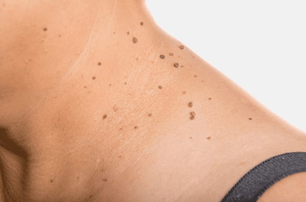 Are you looking for easy skin tag removal Owsestry - then contact Spire today!