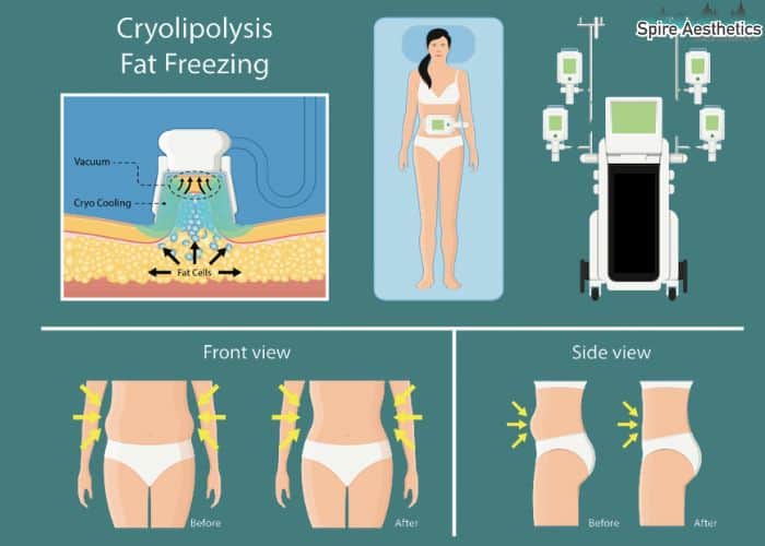 Image of diet and fat freezing combined for best results for Spire Aesthetics Owsestry