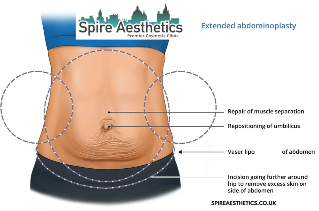 Understanding Loose Skin After Gastric Band Owsestry Surgery and HIFU Treatment 