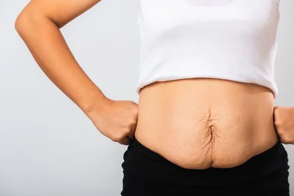 Image of a woman's stomach after weight loss with sagging skin following a gastric band Owsestry