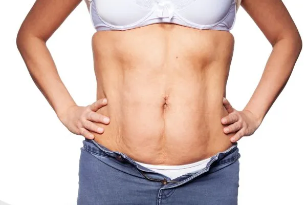 sagging skin on woman's stomach after weight loss injections Owsestry