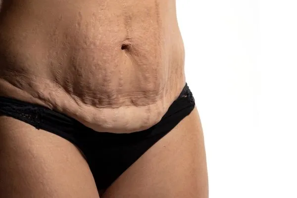 Image of womans stomach after weight loss injections Owsestry showing saggy skin