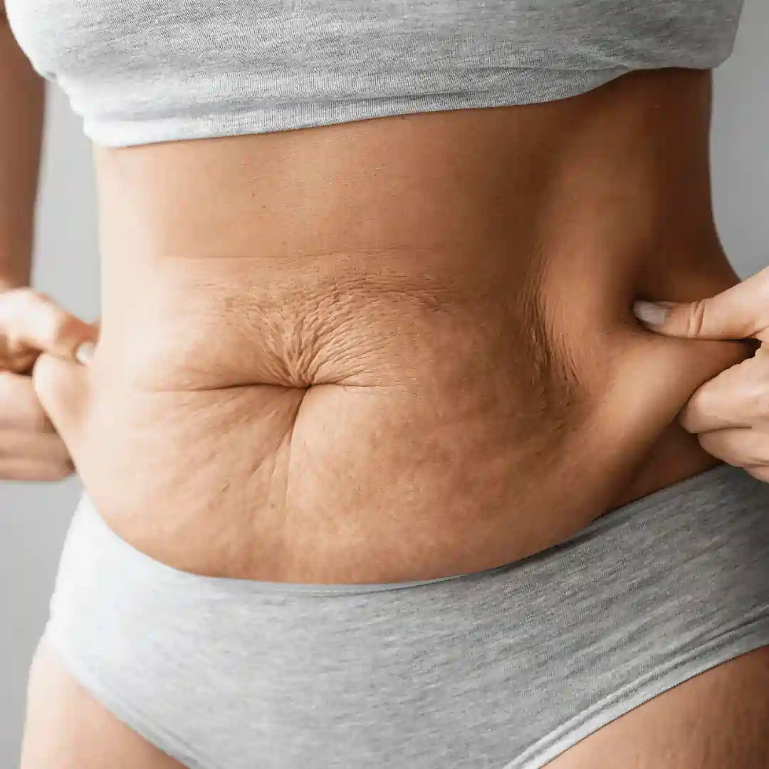 Is It Normal to Have Loose Skin After Pregnancy Owsestry?