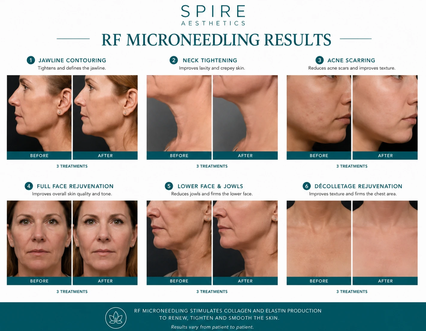 RF Microneedling Skin tightening Owsestry results