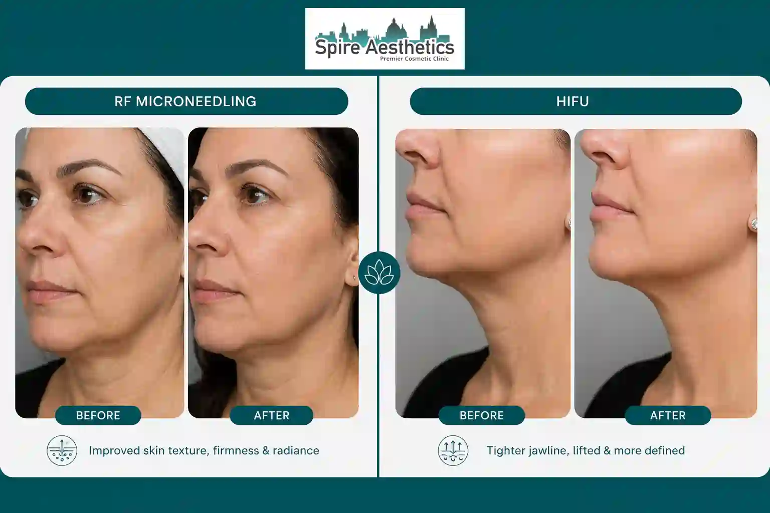 Can RF Microneedling and HIFU Be Combined Owsestry?
