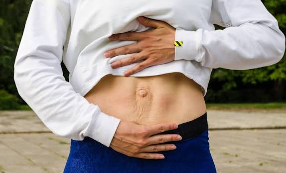 When Could Diastasis Recti Be the Missing Piece of the Puzzle Owsestry?