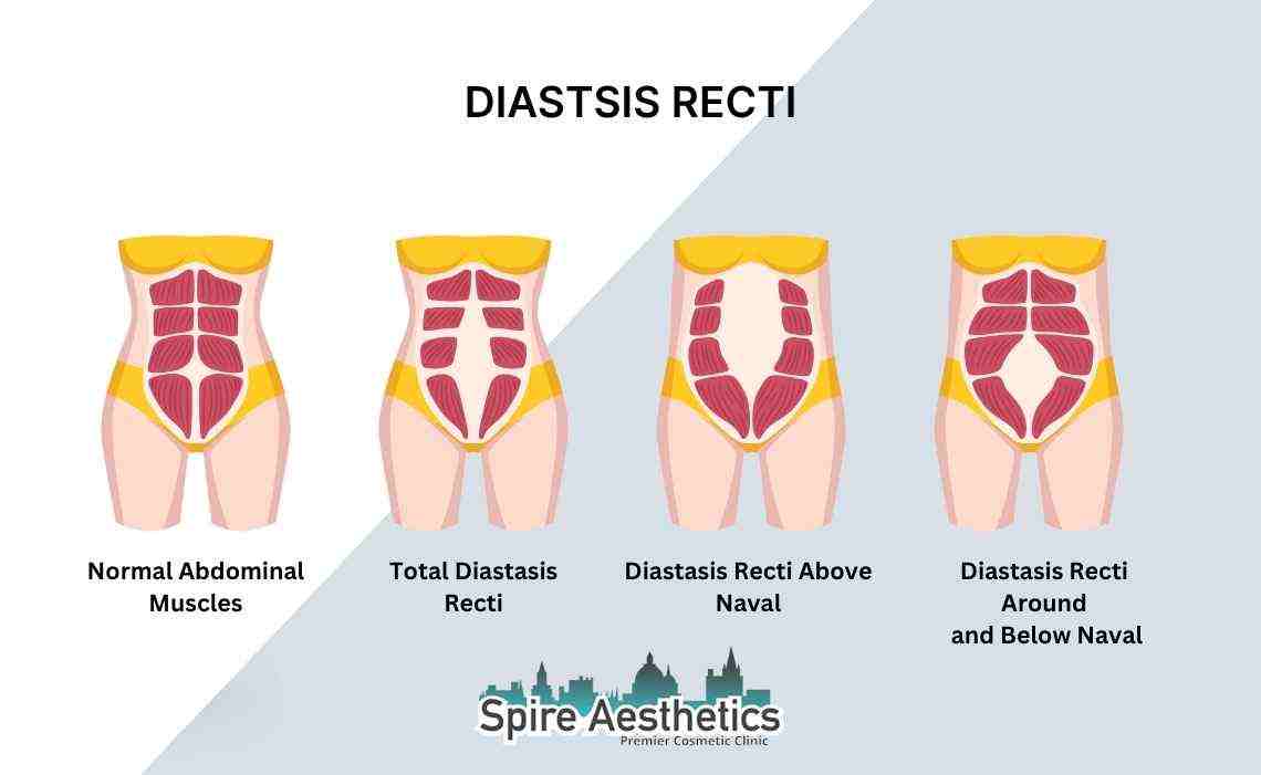 Is Non-Surgical Diastasis Recti Treatment Right for You? Common Concerns Answered Owsestry